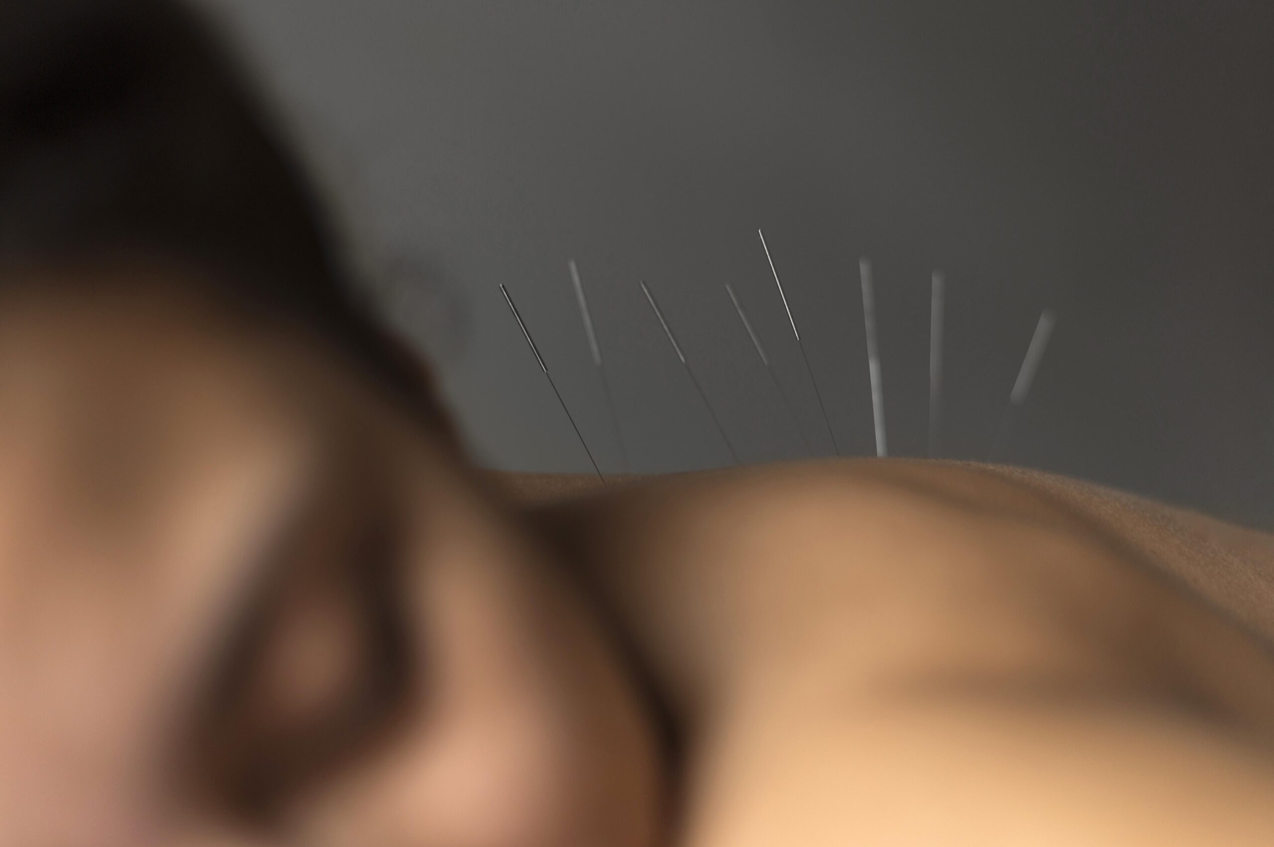 La Acupuntura: Una Terapia Milenaria para el Bienestar